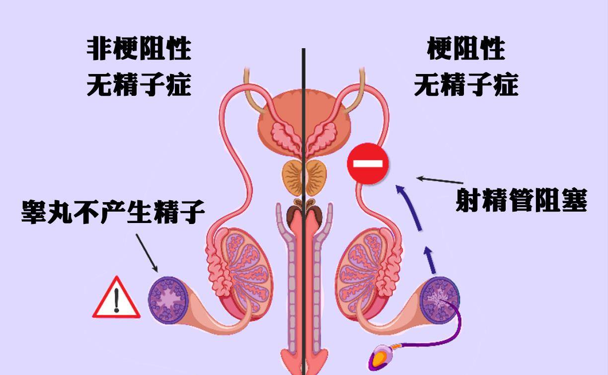 无精症最新研究动态与治疗进展概览